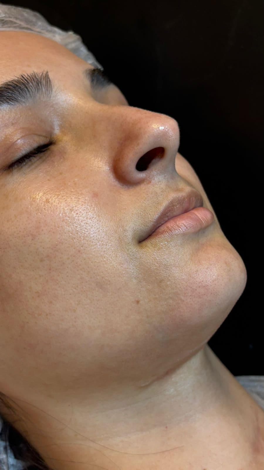 Preenchimento Labial - Antes