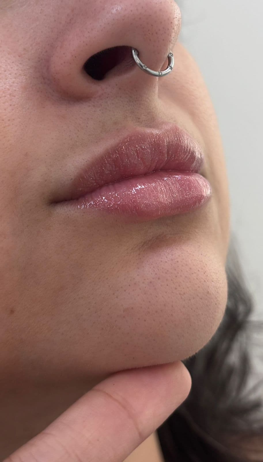 Preenchimento Labial - Depois